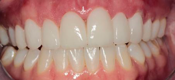 After image